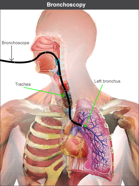Bronchoscope going down through trachea into left bronchus