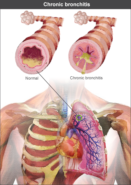 chronic bronchitis lung sounds