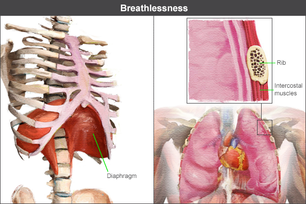 Breathlessness showing diaphragm and intercostal muscles