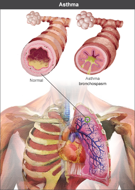 Lungs showing tightening of muscles around airways