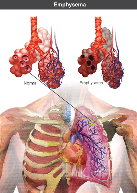 Alveoli show effects of emphysema